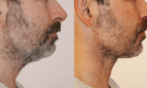 为不被裁员,科技公司男员工扎堆做医美,包括面部拉皮、颈部拉皮、眼睑提升等